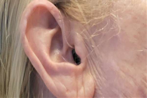 Ciało obce w przewodzie słuchowym zewnętrznym - przyczyny, objawy, diagnoza, leczenie